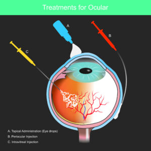 Rashmi Akshikar - Eye injections- antiVegf and steroid implants
